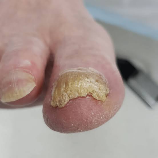 Athlete's Foot