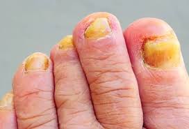Brittle Toenails