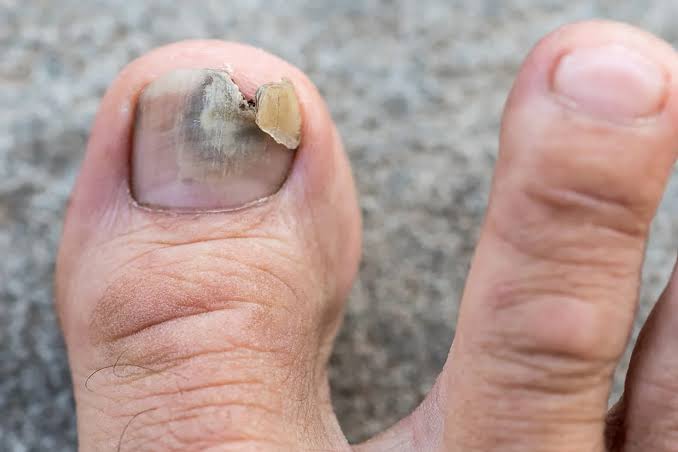Early Toenail Fungus