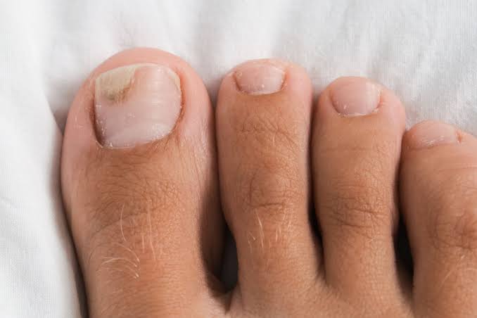 How Fungal Nail Changes Develop