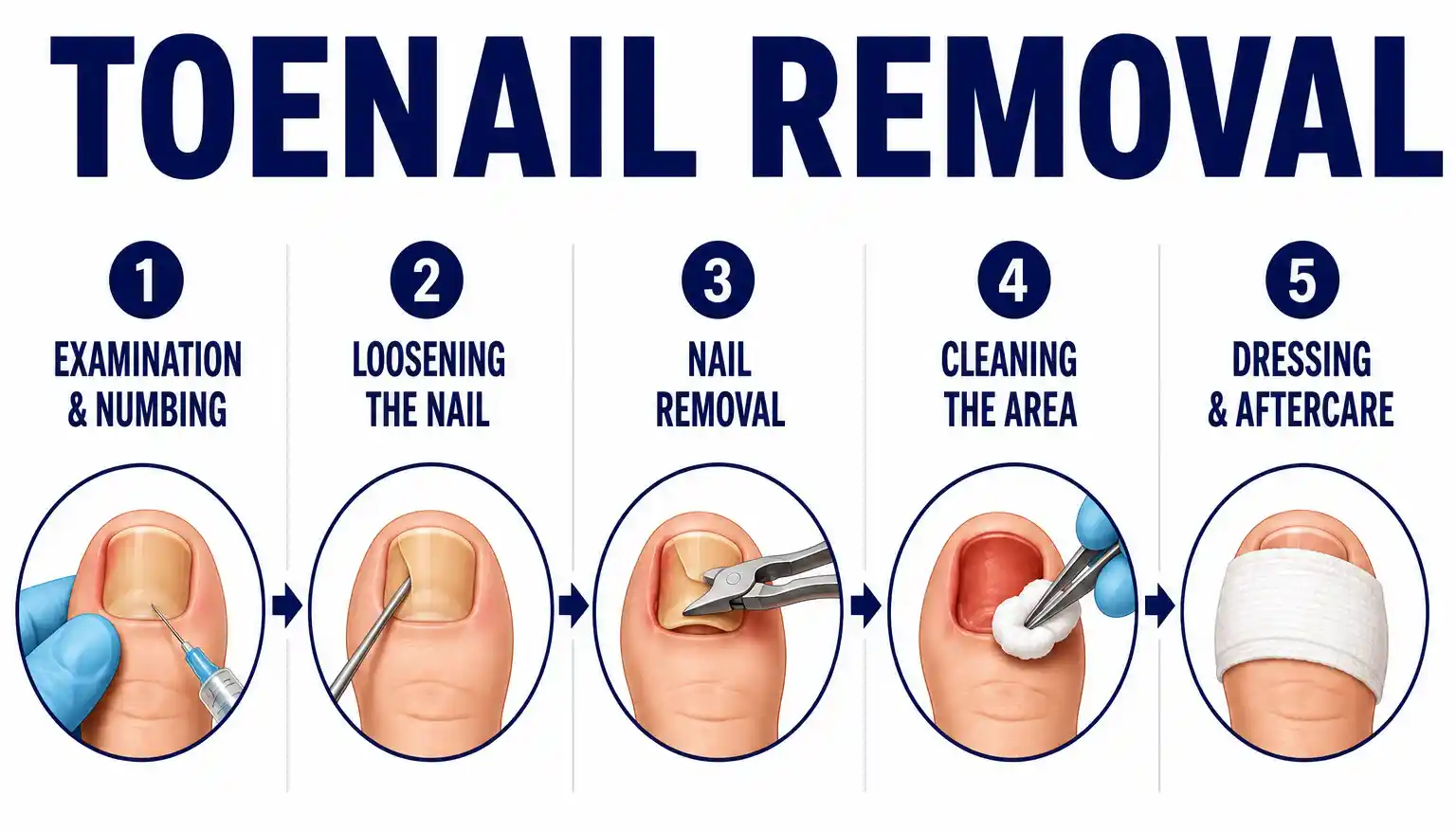 Moisture and Nail Fungus