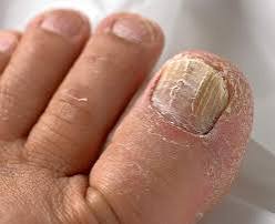 Toenail Discoloration