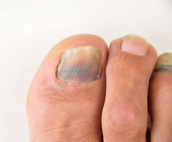 Toenail Fungus Causes