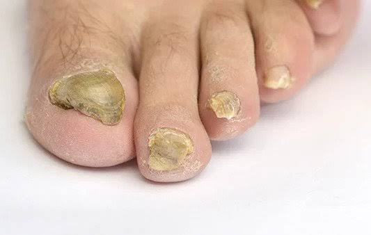 Toenail Fungus Signs